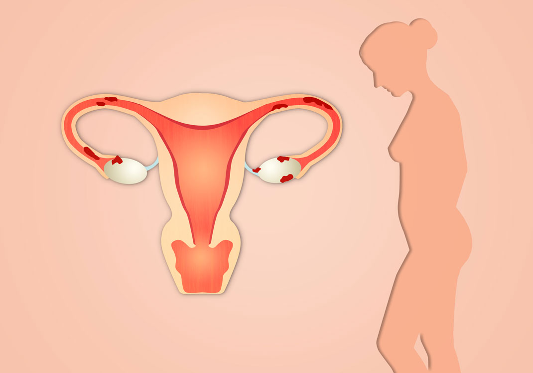 endometrioza uzroci, simptomi i liječenje